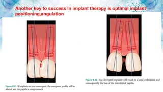 Another key to success in implant therapy is optimal implant
positioning,angulation
 