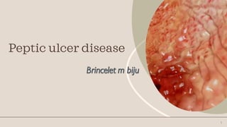 Peptic ulcer disease
1
 