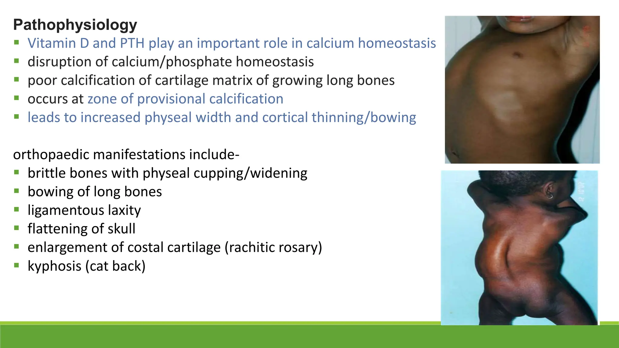 Metabolic diseases in Orthopaedics- Rickets, Osteomalacia and Scurvy | PPTX