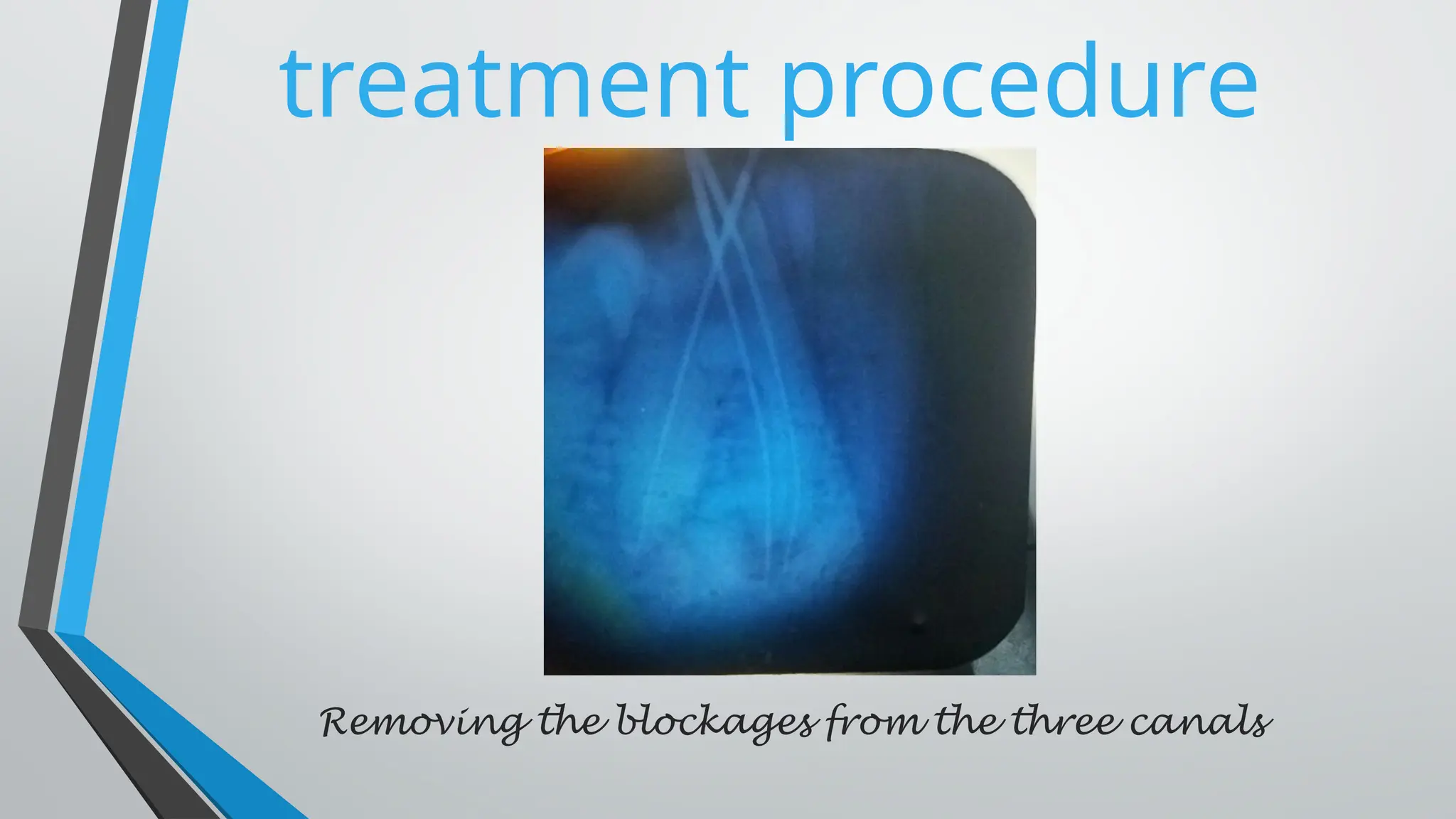 treatment procedure
Removing the blockages from the three canals