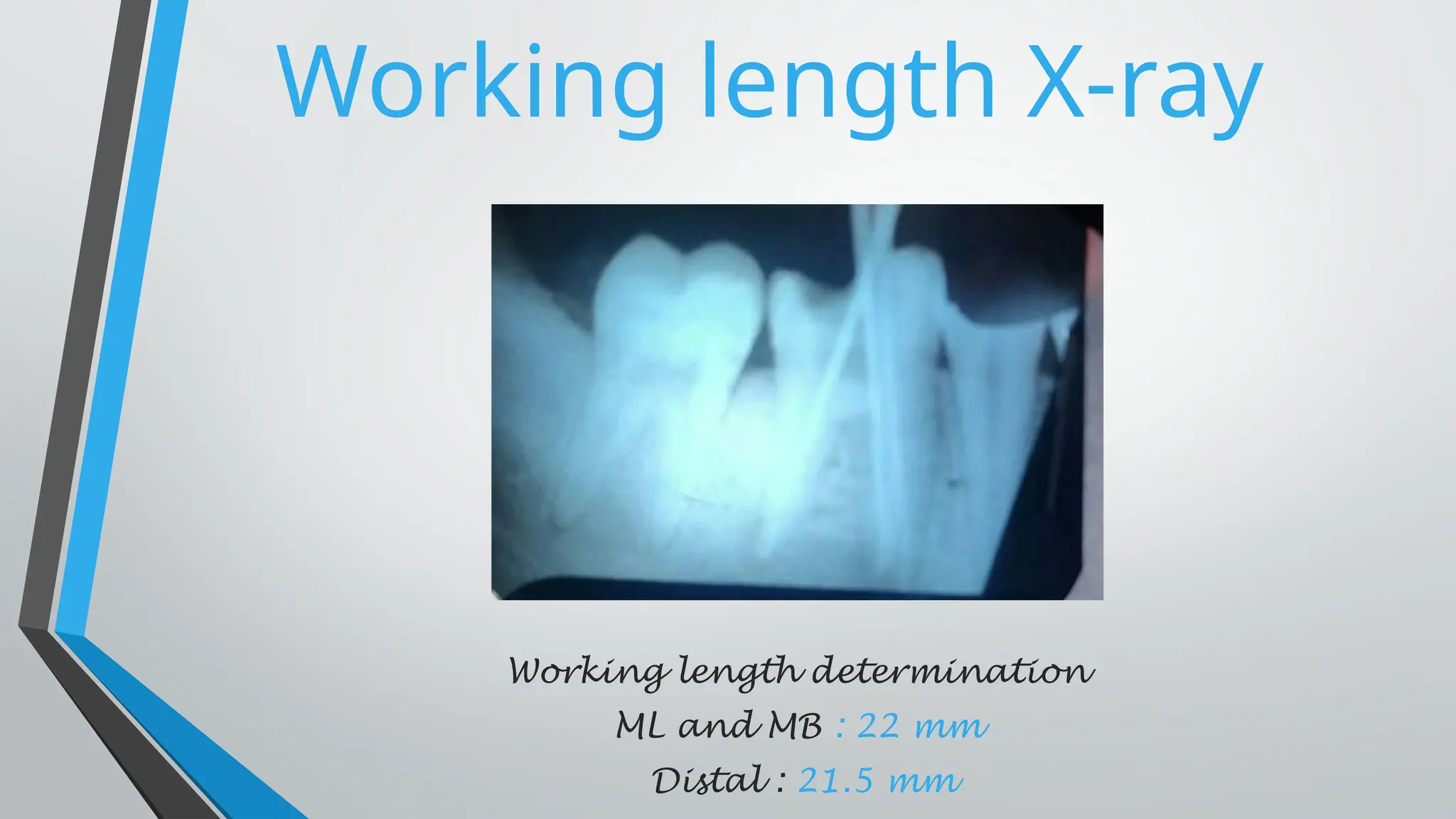 Working length X-ray
Working length determination
ML and MB : 22 mm
Distal : 21.5 mm
