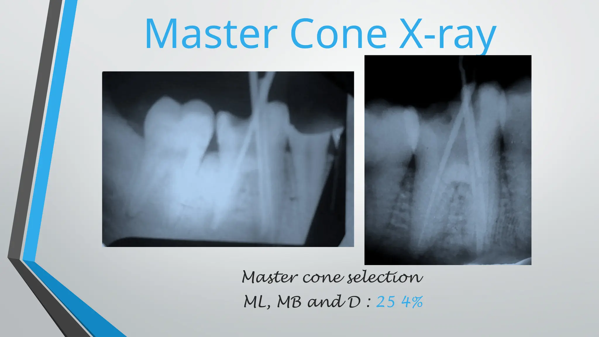 Master Cone X-ray
Master cone selection
ML, MB and D : 25 4%