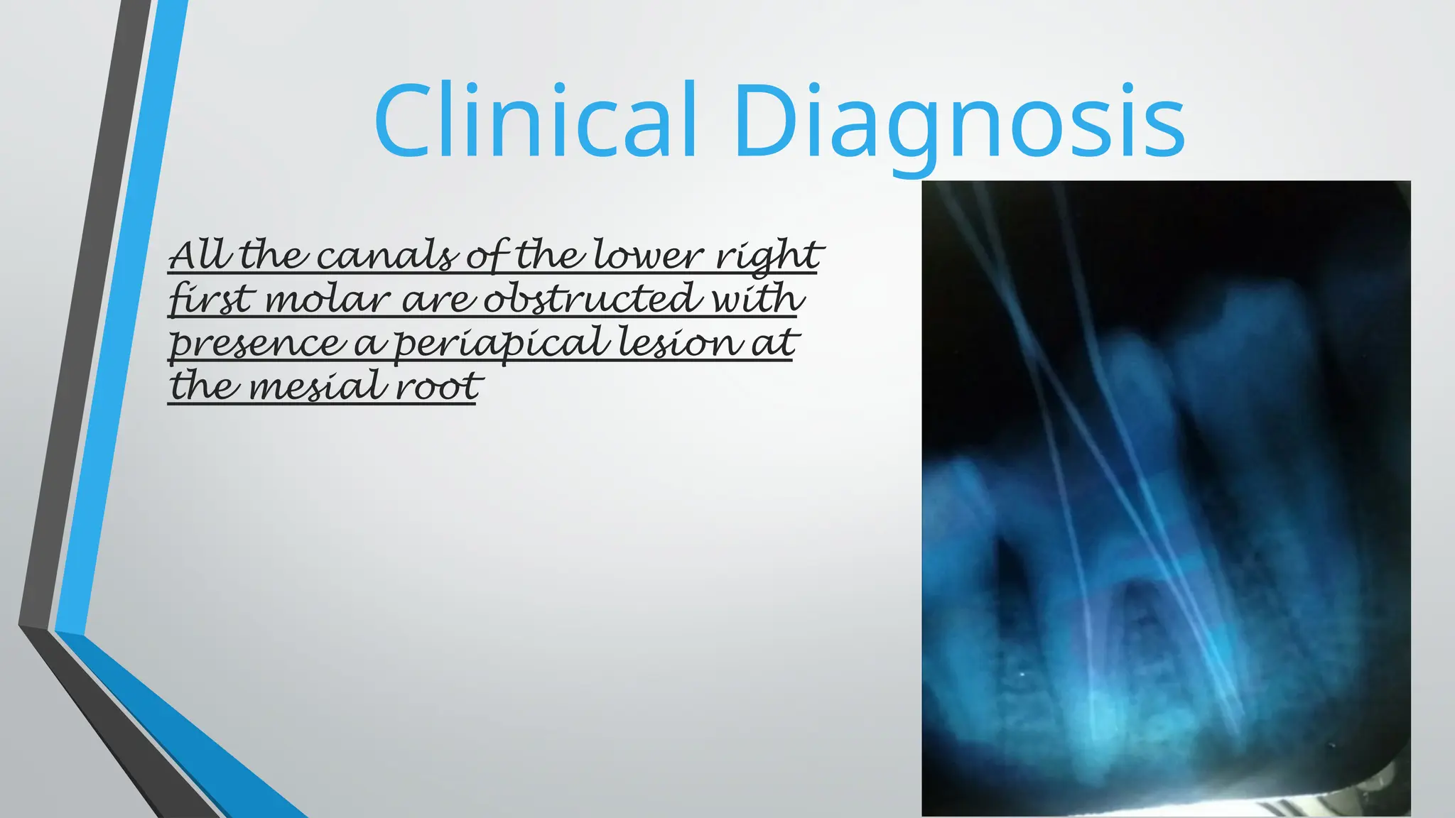 Clinical Diagnosis
All the canals of the lower right
first molar are obstructed with
presence a periapical lesion at
the mesial root