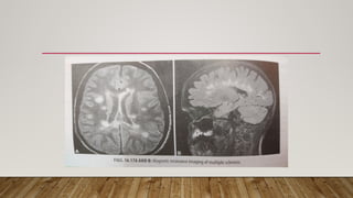 Multiple Sclerosis Diagnosispresentation Pptx