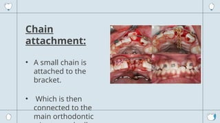 Presentation for Biomechanics for impacted incisors | PPTX