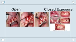 presentation-for-biomechanics-for-impacted-incisors-pptx