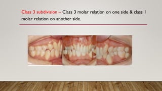Classification of malocclusion various types of malocclusion | PDF