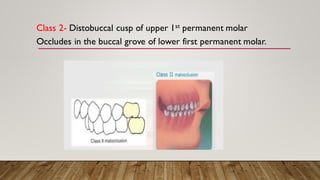 Classification of malocclusion various types of malocclusion | PDF
