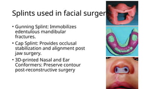 Splints used in facial surgery
• Gunning Splint: Immobilizes
edentulous mandibular
fractures.
• Cap Splint: Provides occlusal
stabilization and alignment post
jaw surgery.
• 3D-printed Nasal and Ear
Conformers: Preserve contour
post-reconstructive surgery
 