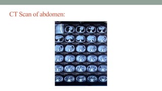 CT Scan of abdomen:
 