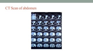 CT Scan of abdomen
 