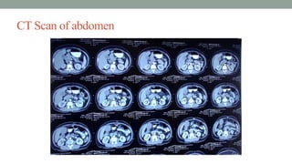 CT Scan of abdomen
 