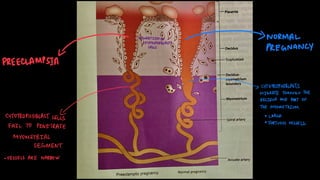 Comprehensive Pathogenesis and Clinical Features of Preeclampsia and ...