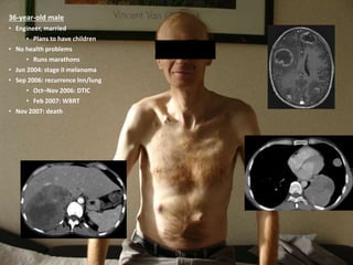 36-year-old male
• Engineer, married
• Plans to have children
• No health problems
• Runs marathons
• Jun 2004: stage II melanoma
• Sep 2006: recurrence lnn/lung
• Oct–Nov 2006: DTIC
• Feb 2007: WBRT
• Nov 2007: death
 