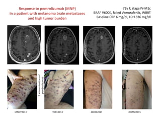 Response to pemrolizumab (MNP)
in a patient with melanoma brain metastases
and high tumor burden
17NOV2014 9DEC2014 26DEC2014
2administrationsof
pembrolizumab
30MAR2015
30MAR2015
15JAN2015
17NOV2015
72y F, stage IV-M1c
BRAF V600E, failed Vemurafenib, WBRT
Baseline CRP 6 mg/dl, LDH 836 mg/dl
26JUN2015
 