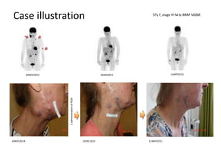 Case illustration
24NOV2014 15DEC2014
1administrationofPEM
57y F, stage IV-M1c BRAF V600E
26NOV2014 20JAN2015 14APR2015
11MAY2015
 