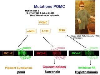 Mutations POMC MC1-R MC4-R MC2-R POMC  MSH ACTH MSH Surrenale Hypothalamus peau Pigment Eumelanine Inhibition PA Glucorticoïdes s s Mution exon 3 (G->T nt7013 & del at 7133) No ACTH and aMSH synthesis (Krude et al, Nature genet, 1998) Et JCEM 2003 