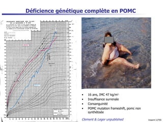 Déficience génétique complète en POMC  16 ans, IMC 47 kg/m 2,   Insuffisance surrenale Consanguinité POMC mutation frameshift, pomc non synthétisée Clement & Leger unpublished Inserm U755 