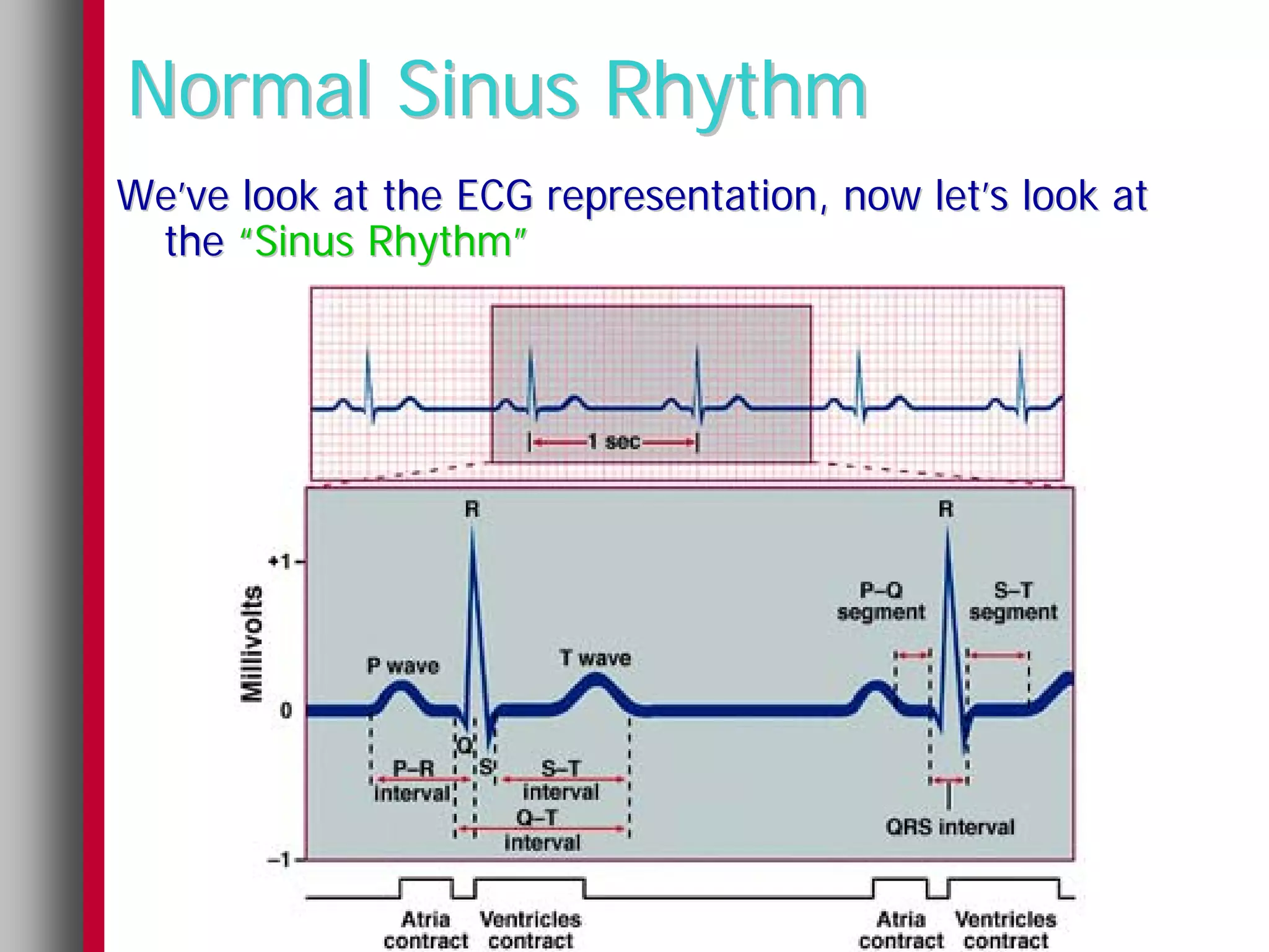 Normal Sinus Rhythm
We’ve look at the ECG representation, now let’s look at
 the “Sinus Rhythm”
 