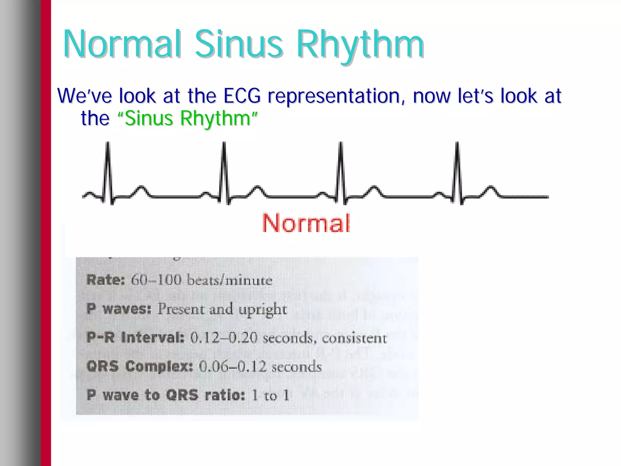Normal Sinus Rhythm
We’ve look at the ECG representation, now let’s look at
 the “Sinus Rhythm”
 