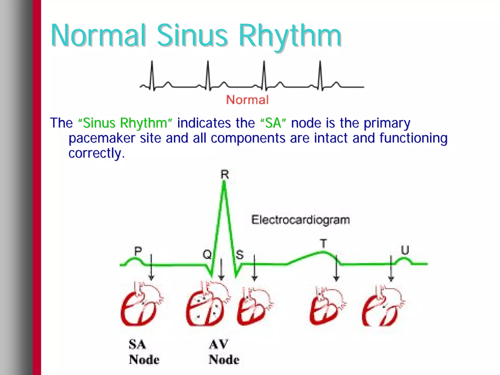 Normal Sinus Rhythm

The “Sinus Rhythm” indicates the “SA” node is the primary
  pacemaker site and all components are intact and functioning
  correctly.
 
