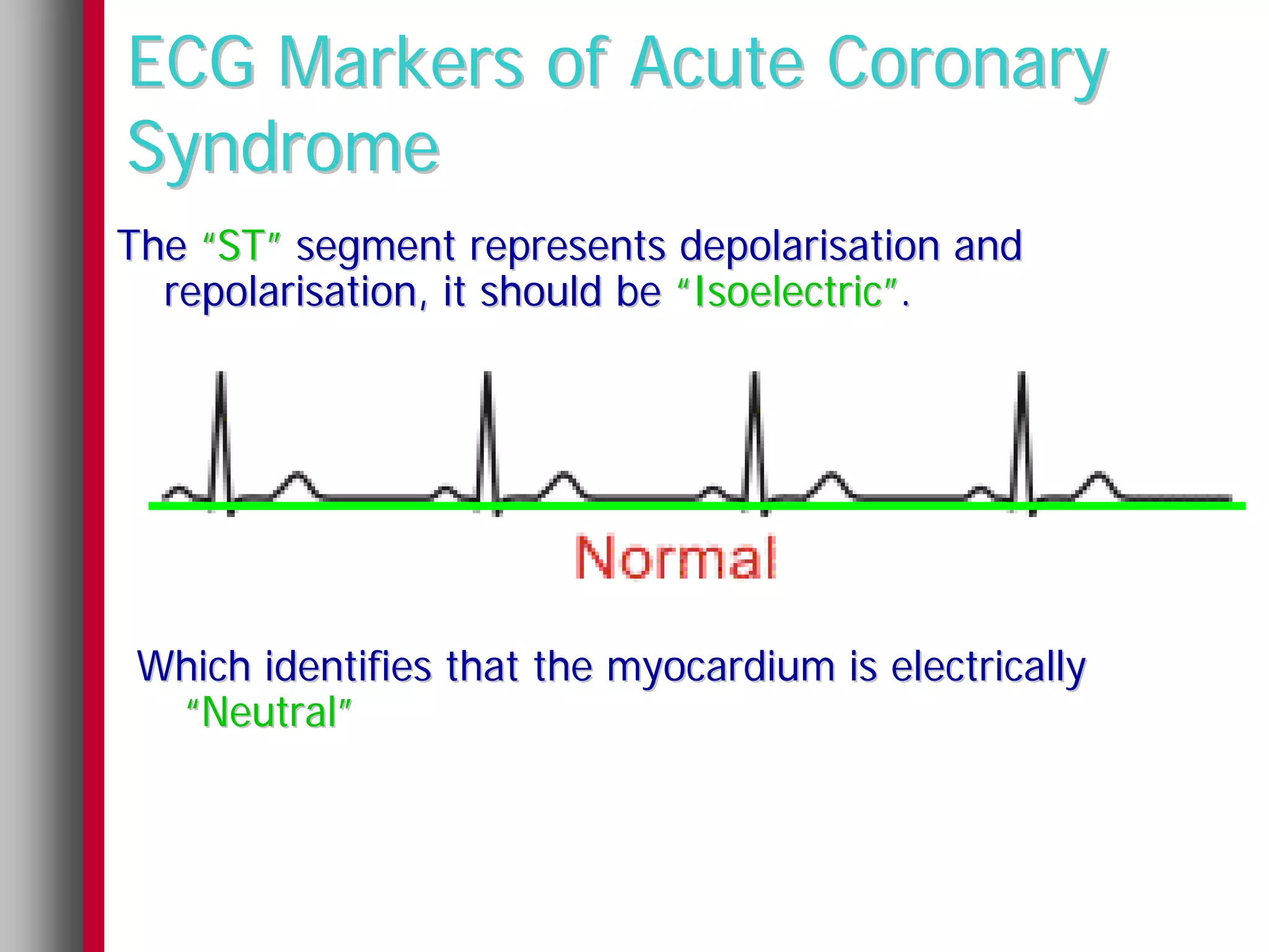 ECG Markers of Acute Coronary
Syndrome
The “ST” segment represents depolarisation and
  repolarisation, it should be “Isoelectric”.




 Which identifies that the myocardium is electrically
  “Neutral”
 