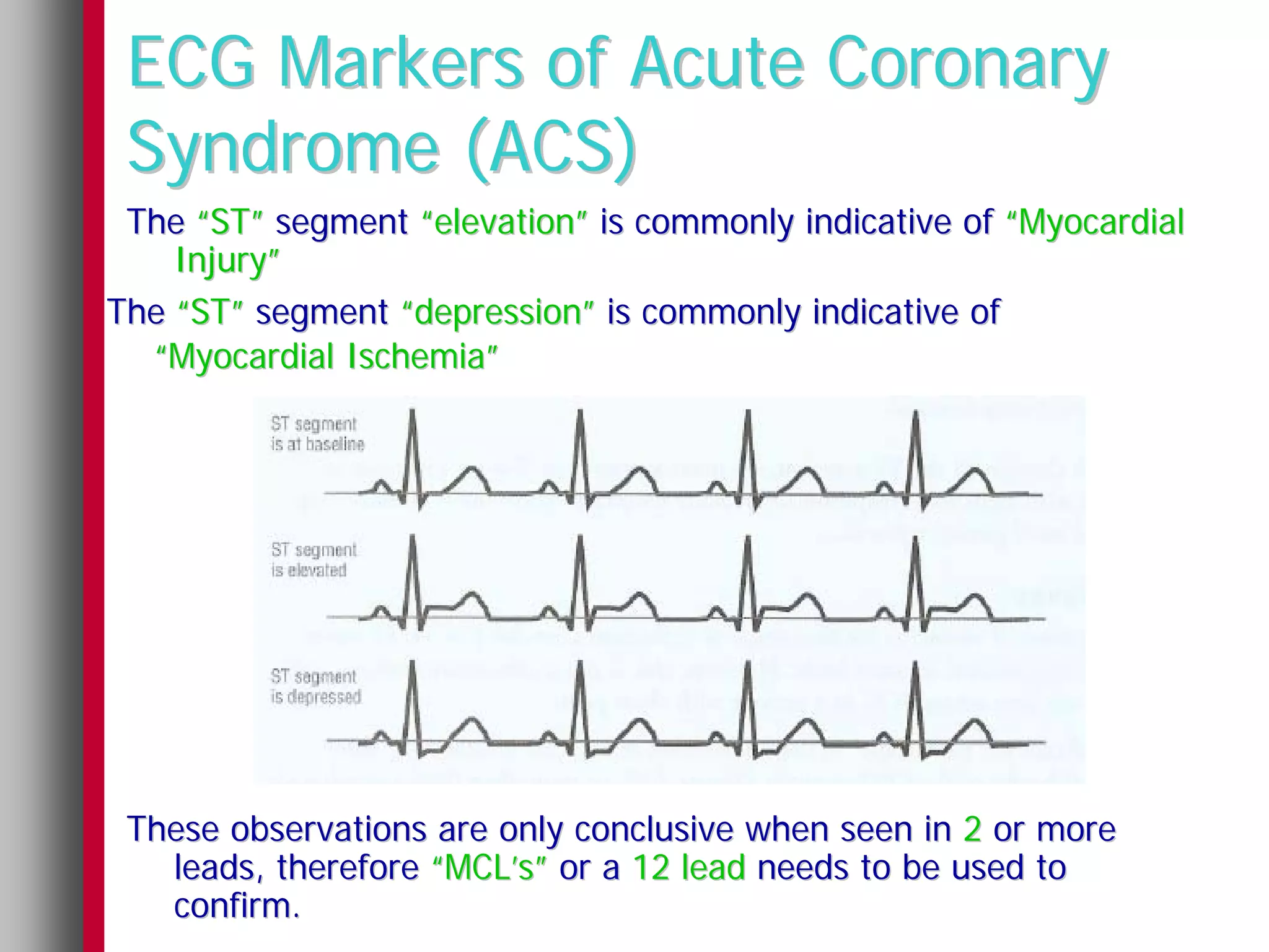 ECG Markers of Acute Coronary
 Syndrome (ACS)
 The “ST” segment “elevation” is commonly indicative of “Myocardial
    Injury”
The “ST” segment “depression” is commonly indicative of
  “Myocardial Ischemia”




 These observations are only conclusive when seen in 2 or more
   leads, therefore “MCL’s” or a 12 lead needs to be used to
   confirm.
 