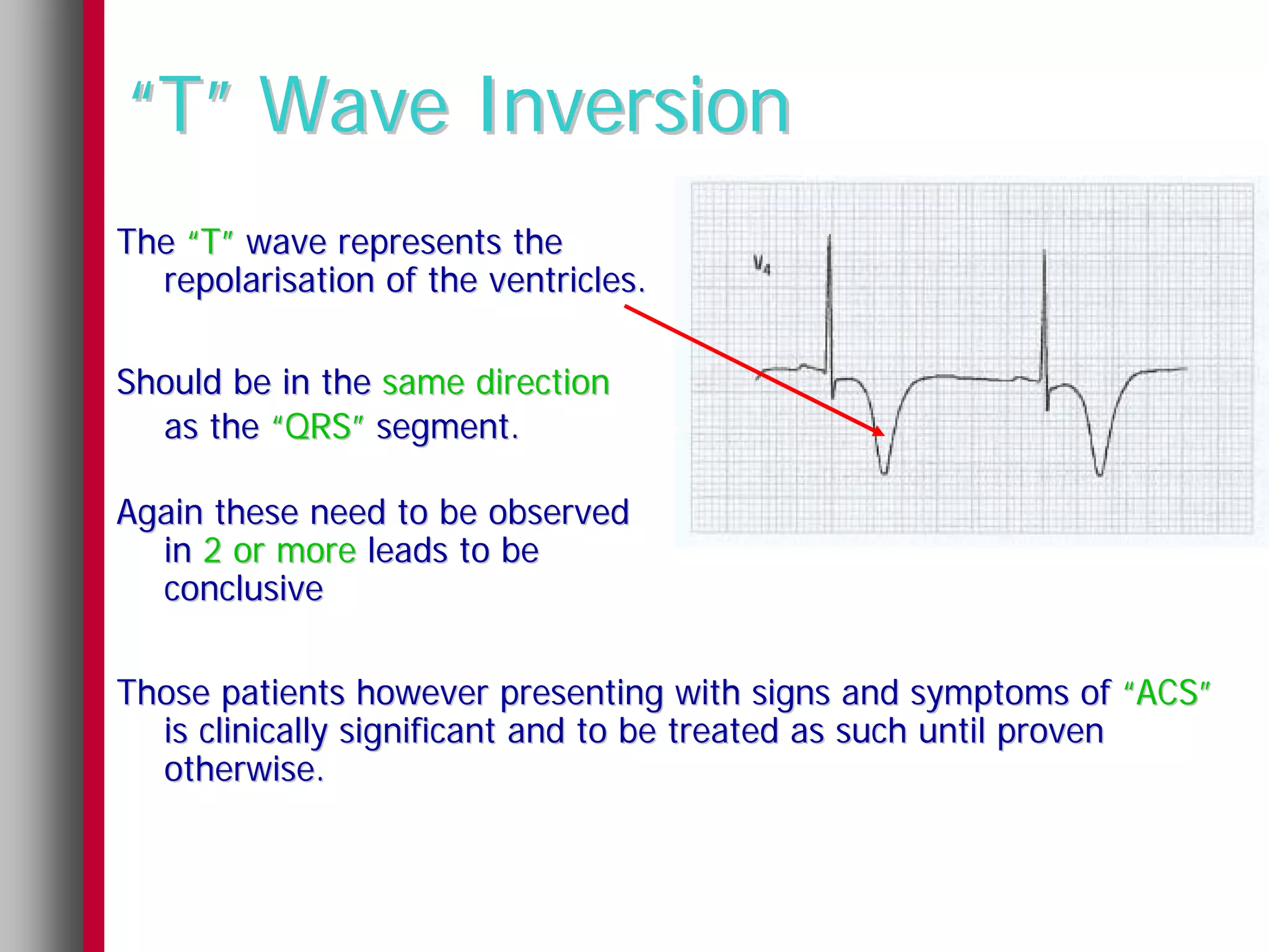 “T” Wave Inversion
The “T” wave represents the
  repolarisation of the ventricles.

Should be in the same direction
  as the “QRS” segment.

Again these need to be observed
  in 2 or more leads to be
  conclusive

Those patients however presenting with signs and symptoms of “ACS”
  is clinically significant and to be treated as such until proven
  otherwise.
 