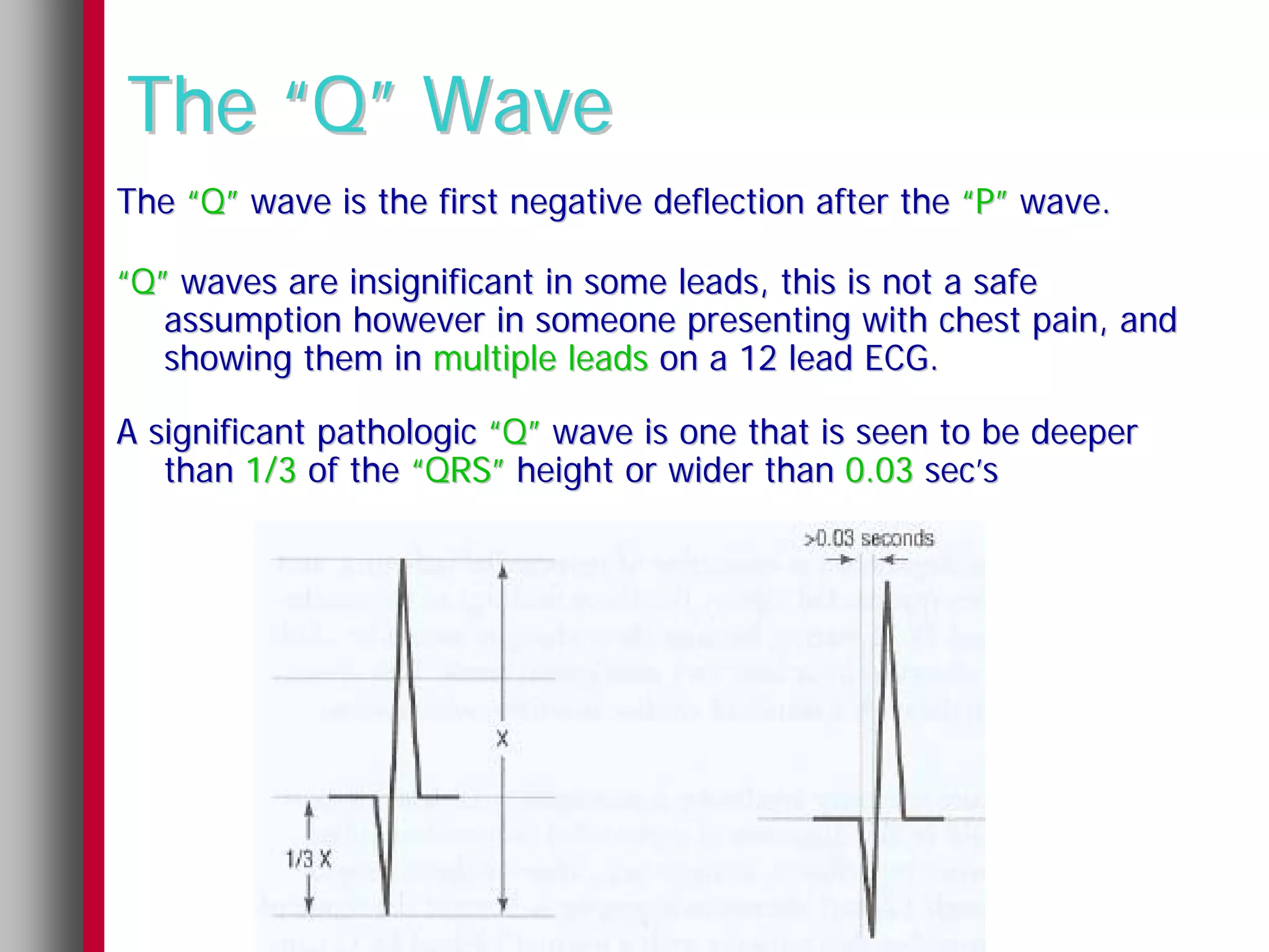 The “Q” Wave
The “Q” wave is the first negative deflection after the “P” wave.

“Q” waves are insignificant in some leads, this is not a safe
   assumption however in someone presenting with chest pain, and
   showing them in multiple leads on a 12 lead ECG.

A significant pathologic “Q” wave is one that is seen to be deeper
   than 1/3 of the “QRS” height or wider than 0.03 sec’s
 