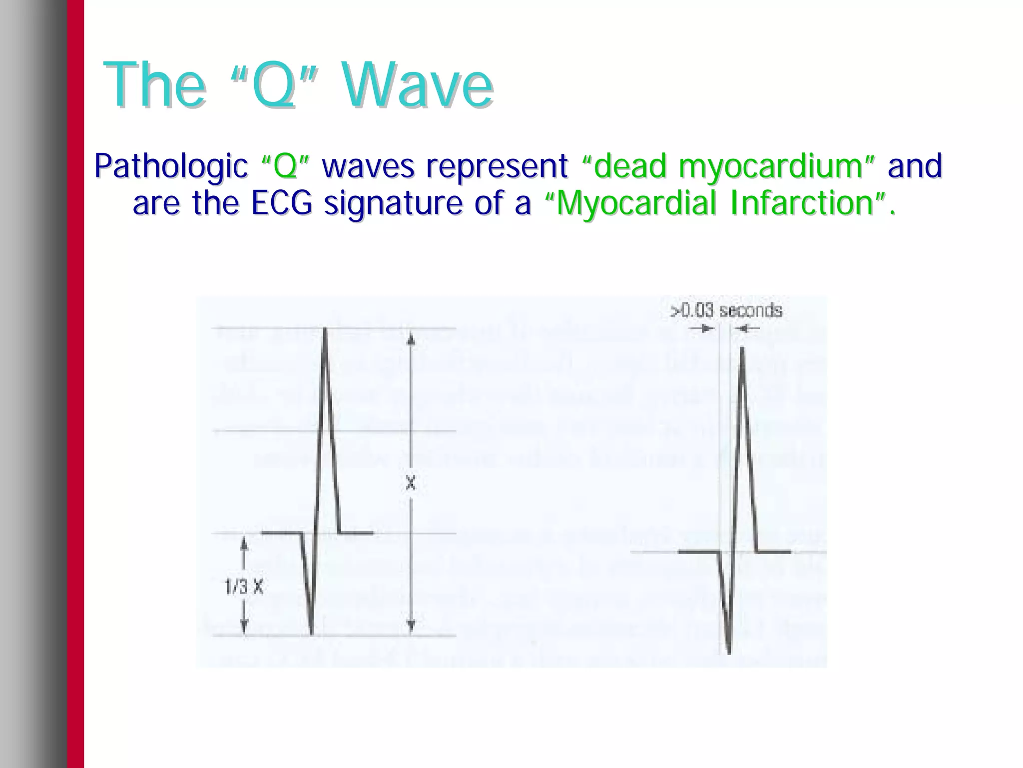The “Q” Wave
Pathologic “Q” waves represent “dead myocardium” and
  are the ECG signature of a “Myocardial Infarction”.
 
