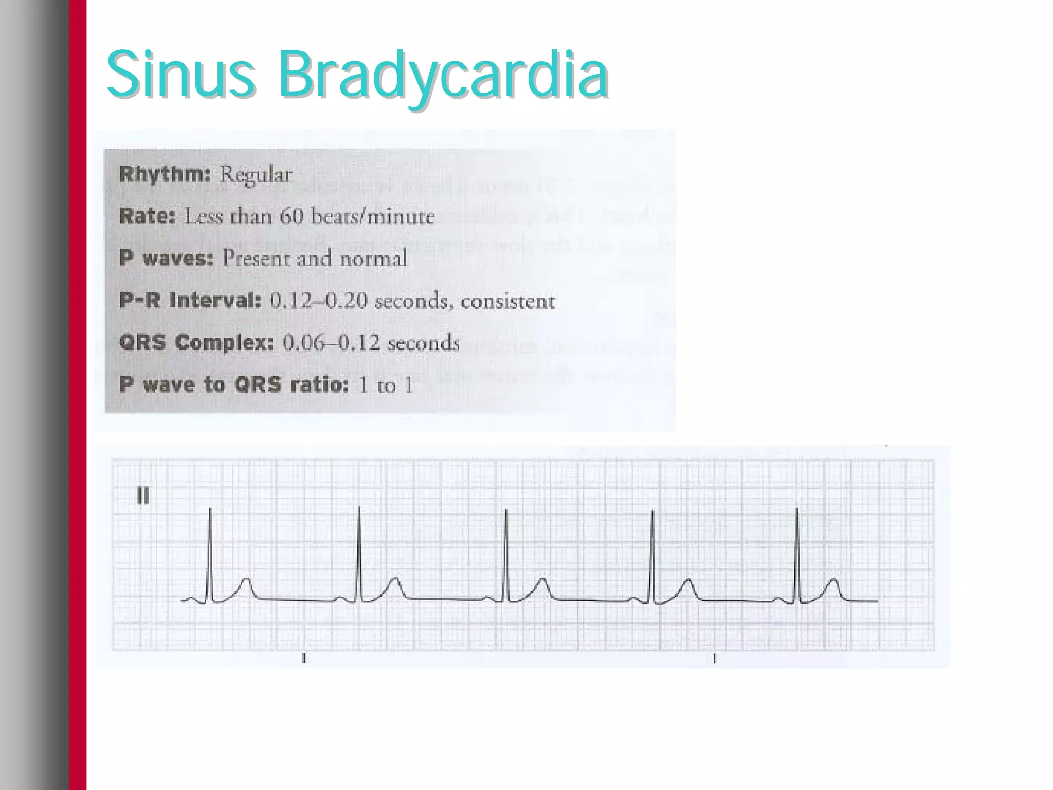 Sinus Bradycardia
 