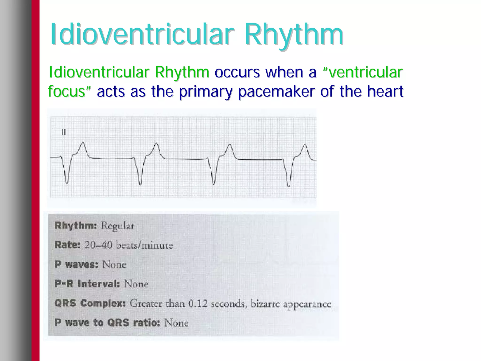 Idioventricular Rhythm
Idioventricular Rhythm occurs when a “ventricular
focus” acts as the primary pacemaker of the heart
 
