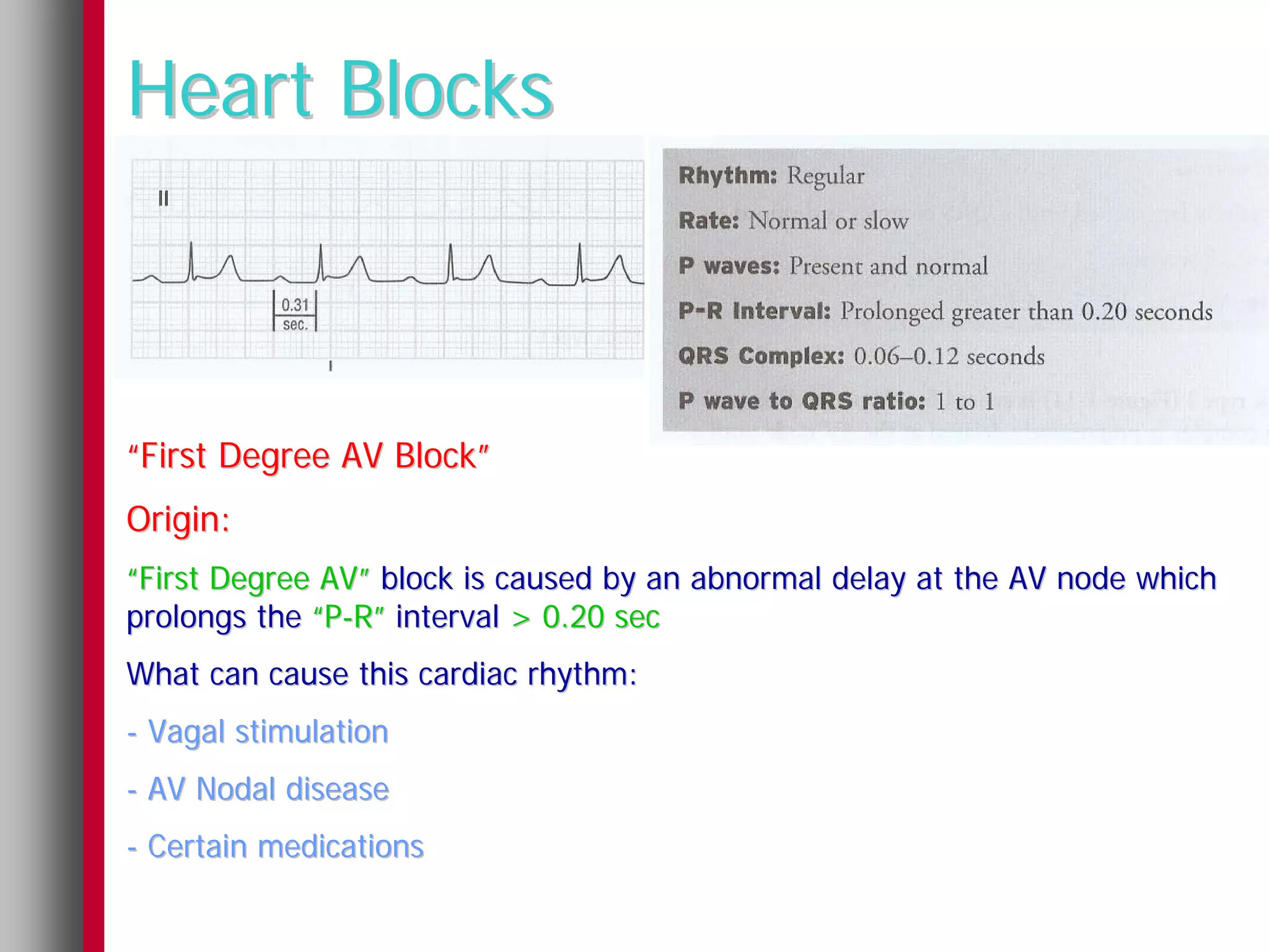 Heart Blocks



“First Degree AV Block”
Origin:
“First Degree AV” block is caused by an abnormal delay at the AV node which
prolongs the “P-R” interval > 0.20 sec
What can cause this cardiac rhythm:
- Vagal stimulation
- AV Nodal disease
- Certain medications
 