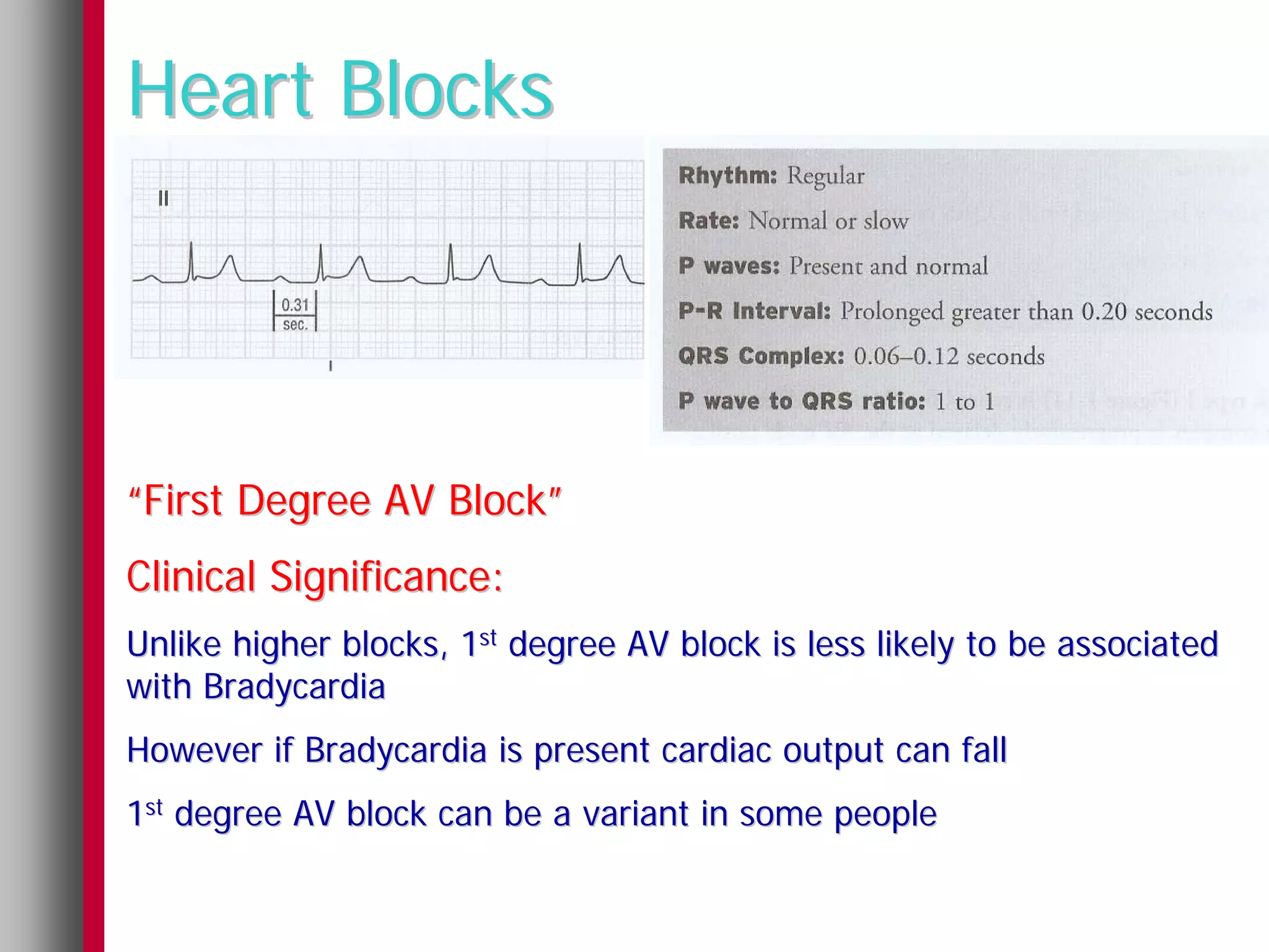 Heart Blocks




“First Degree AV Block”
Clinical Significance:
Unlike higher blocks, 1st degree AV block is less likely to be associated
with Bradycardia
However if Bradycardia is present cardiac output can fall
1st degree AV block can be a variant in some people
 