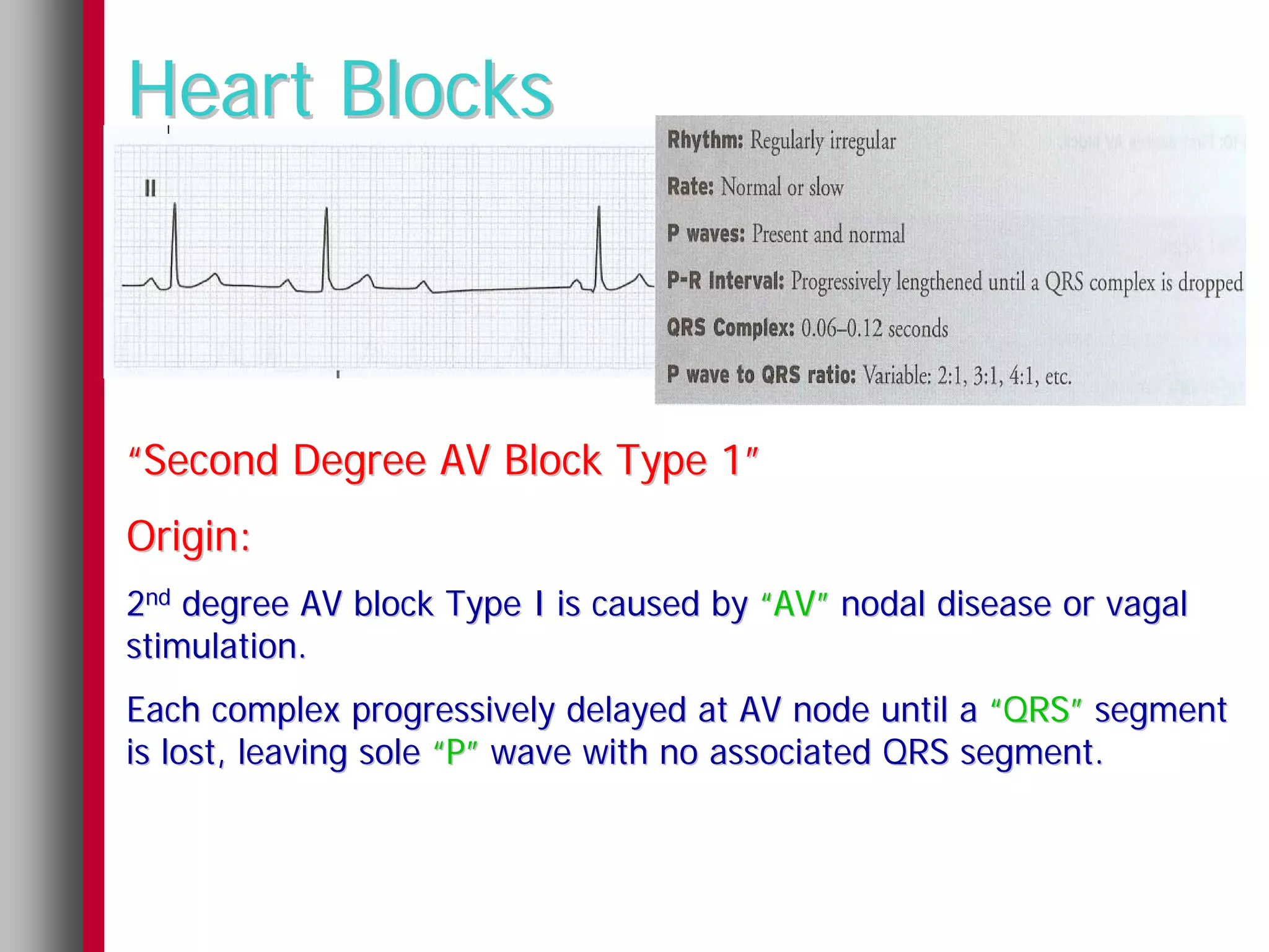 Heart Blocks



“Second Degree AV Block Type 1”
Origin:
2nd degree AV block Type I is caused by “AV” nodal disease or vagal
stimulation.
Each complex progressively delayed at AV node until a “QRS” segment
is lost, leaving sole “P” wave with no associated QRS segment.
 