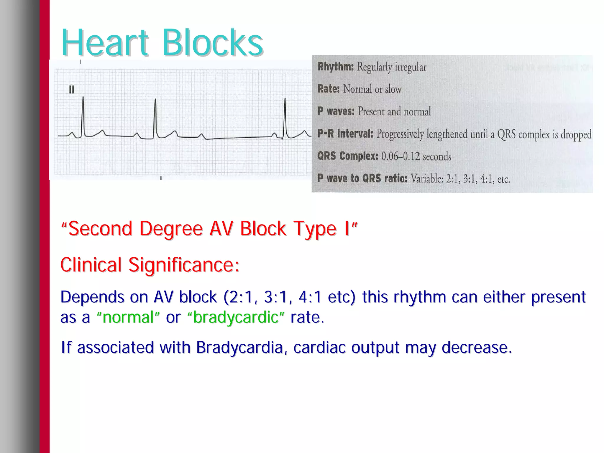 Heart Blocks



“Second Degree AV Block Type I”
Clinical Significance:
Depends on AV block (2:1, 3:1, 4:1 etc) this rhythm can either present
as a “normal” or “bradycardic” rate.
If associated with Bradycardia, cardiac output may decrease.
 