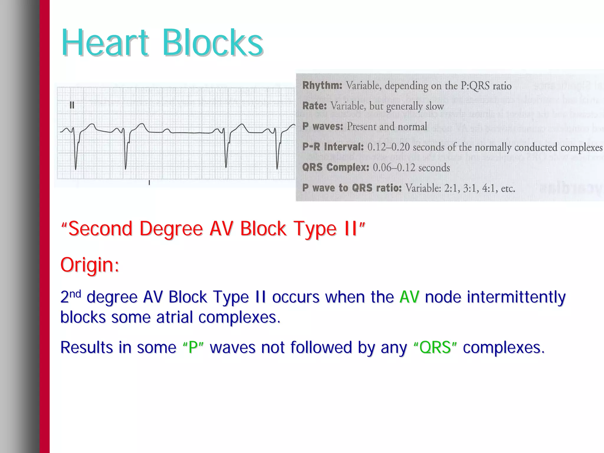 Heart Blocks



“Second Degree AV Block Type II”
Origin:
2nd degree AV Block Type II occurs when the AV node intermittently
blocks some atrial complexes.
Results in some “P” waves not followed by any “QRS” complexes.
 