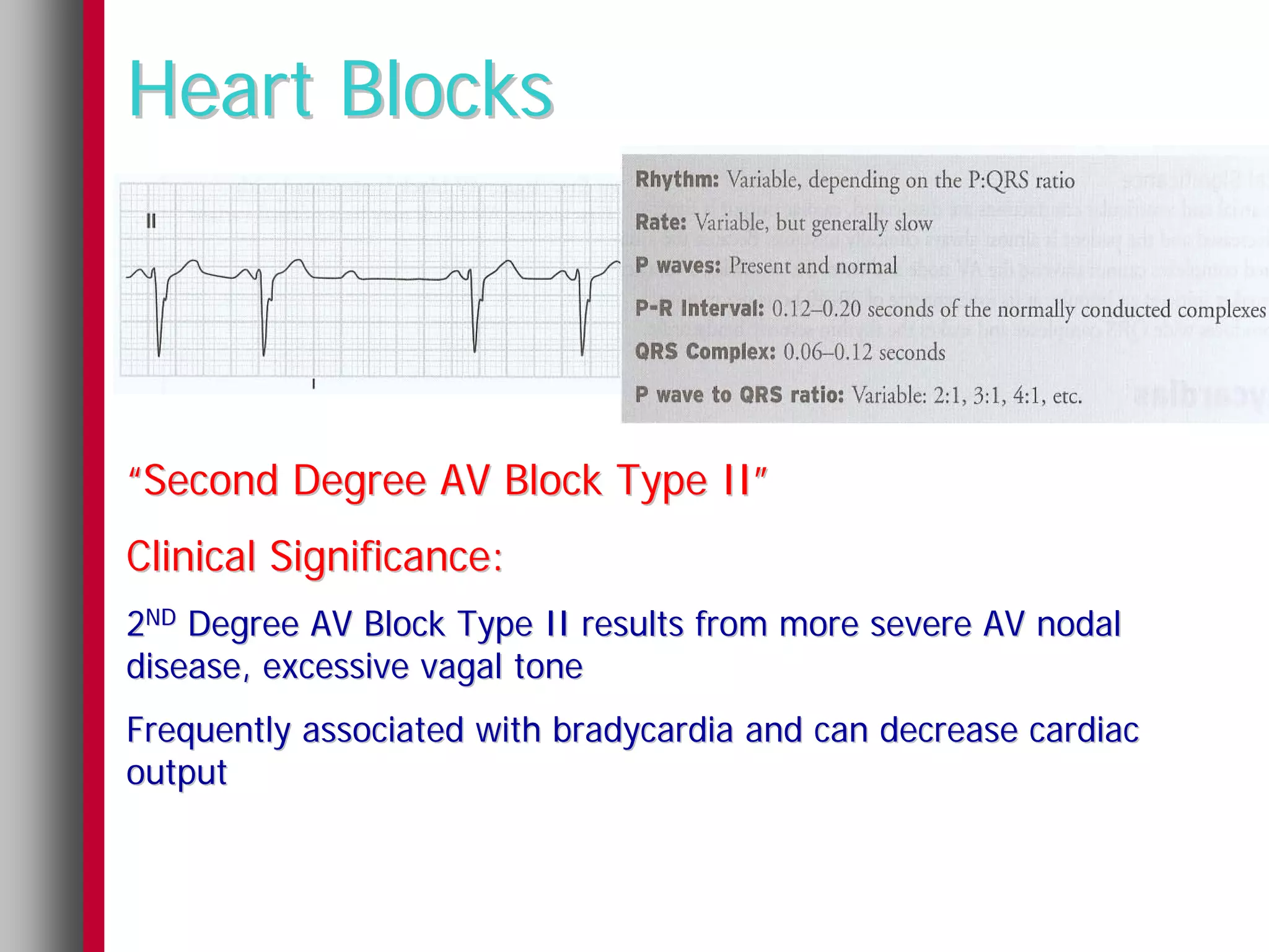 Heart Blocks



“Second Degree AV Block Type II”
Clinical Significance:
2ND Degree AV Block Type II results from more severe AV nodal
disease, excessive vagal tone
Frequently associated with bradycardia and can decrease cardiac
output
 