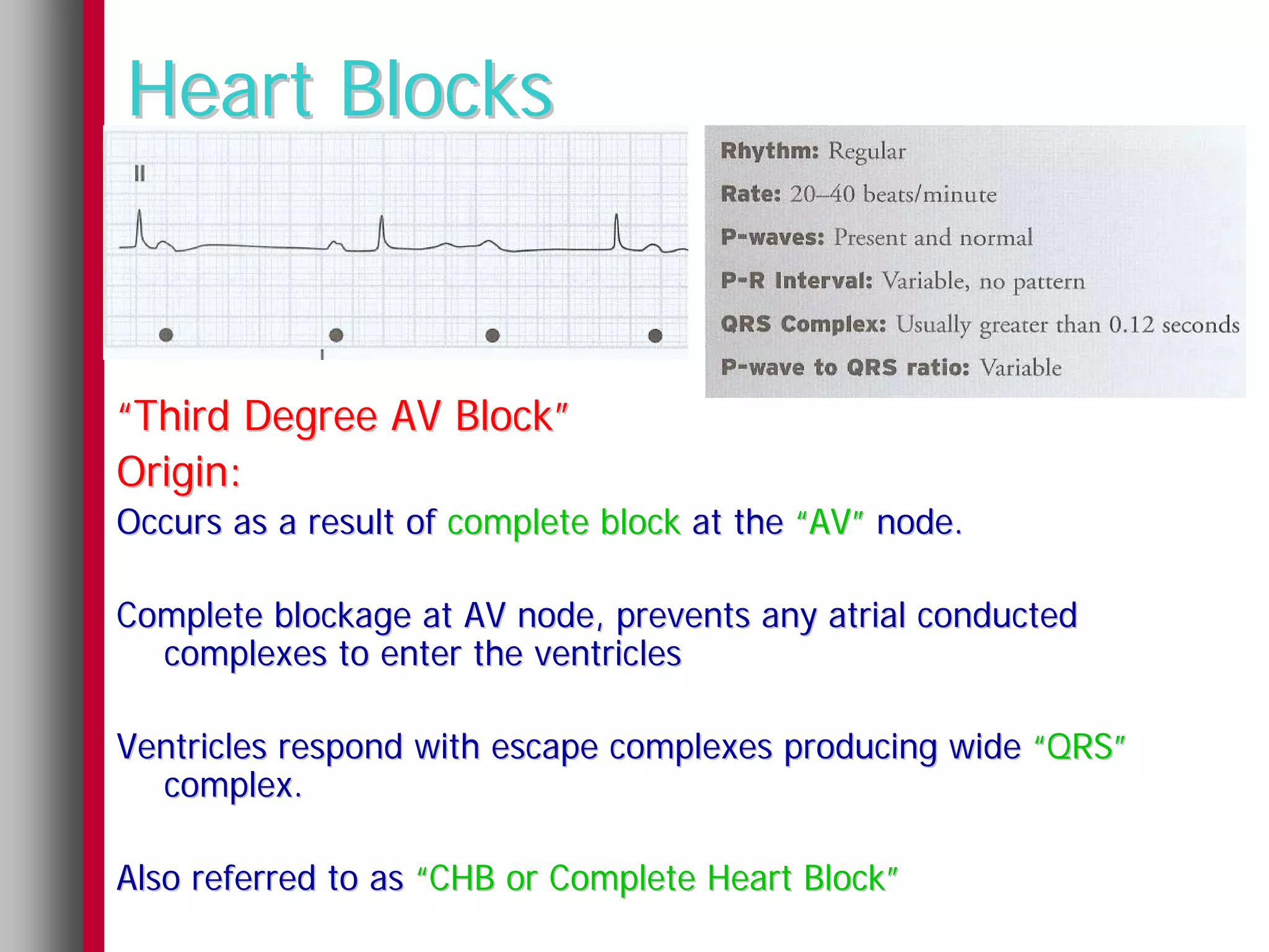 Heart Blocks



“Third Degree AV Block”
Origin:
Occurs as a result of complete block at the “AV” node.

Complete blockage at AV node, prevents any atrial conducted
  complexes to enter the ventricles

Ventricles respond with escape complexes producing wide “QRS”
  complex.

Also referred to as “CHB or Complete Heart Block”
 
