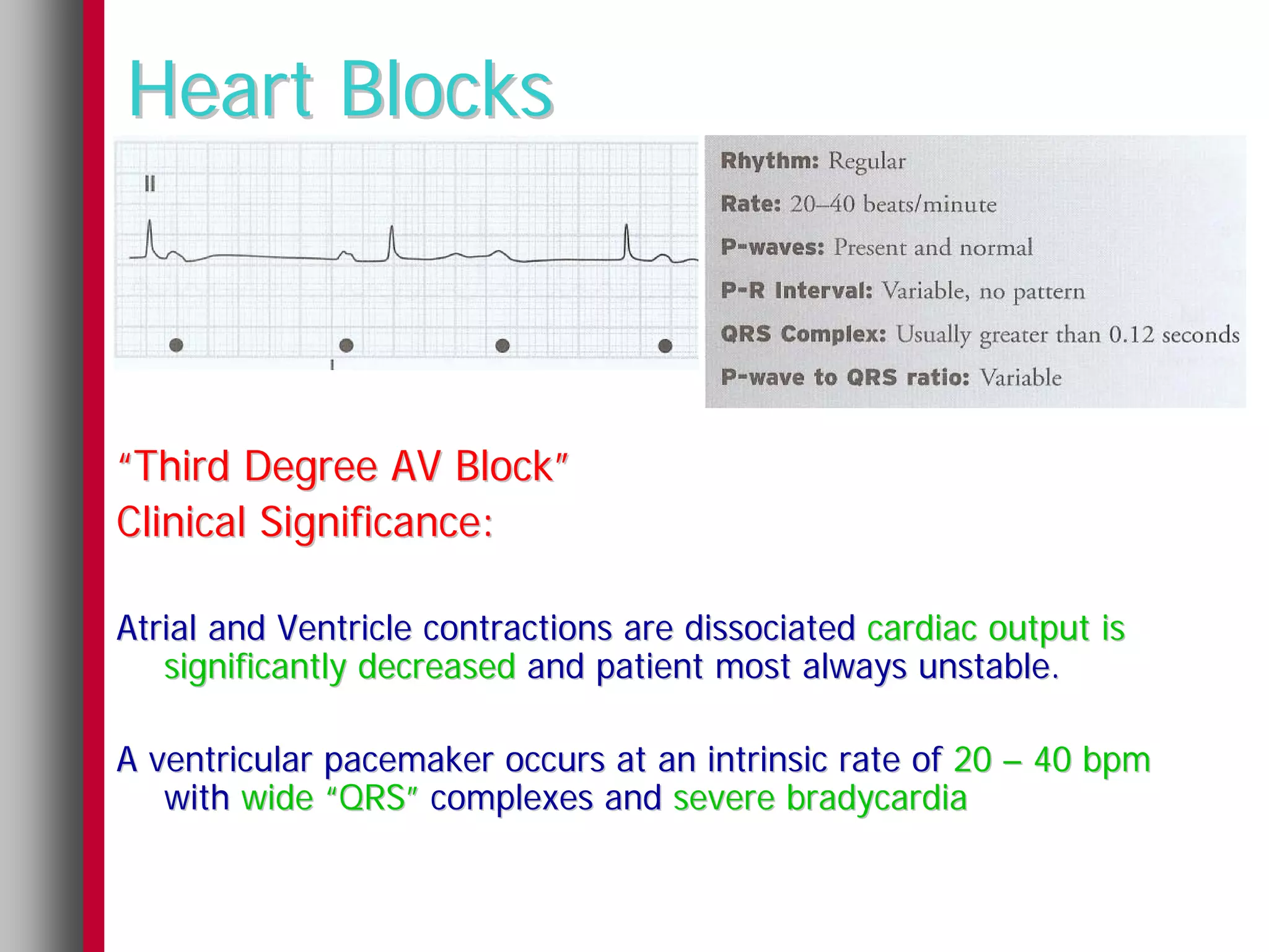 Heart Blocks



“Third Degree AV Block”
Clinical Significance:

Atrial and Ventricle contractions are dissociated cardiac output is
   significantly decreased and patient most always unstable.

A ventricular pacemaker occurs at an intrinsic rate of 20 – 40 bpm
   with wide “QRS” complexes and severe bradycardia
 