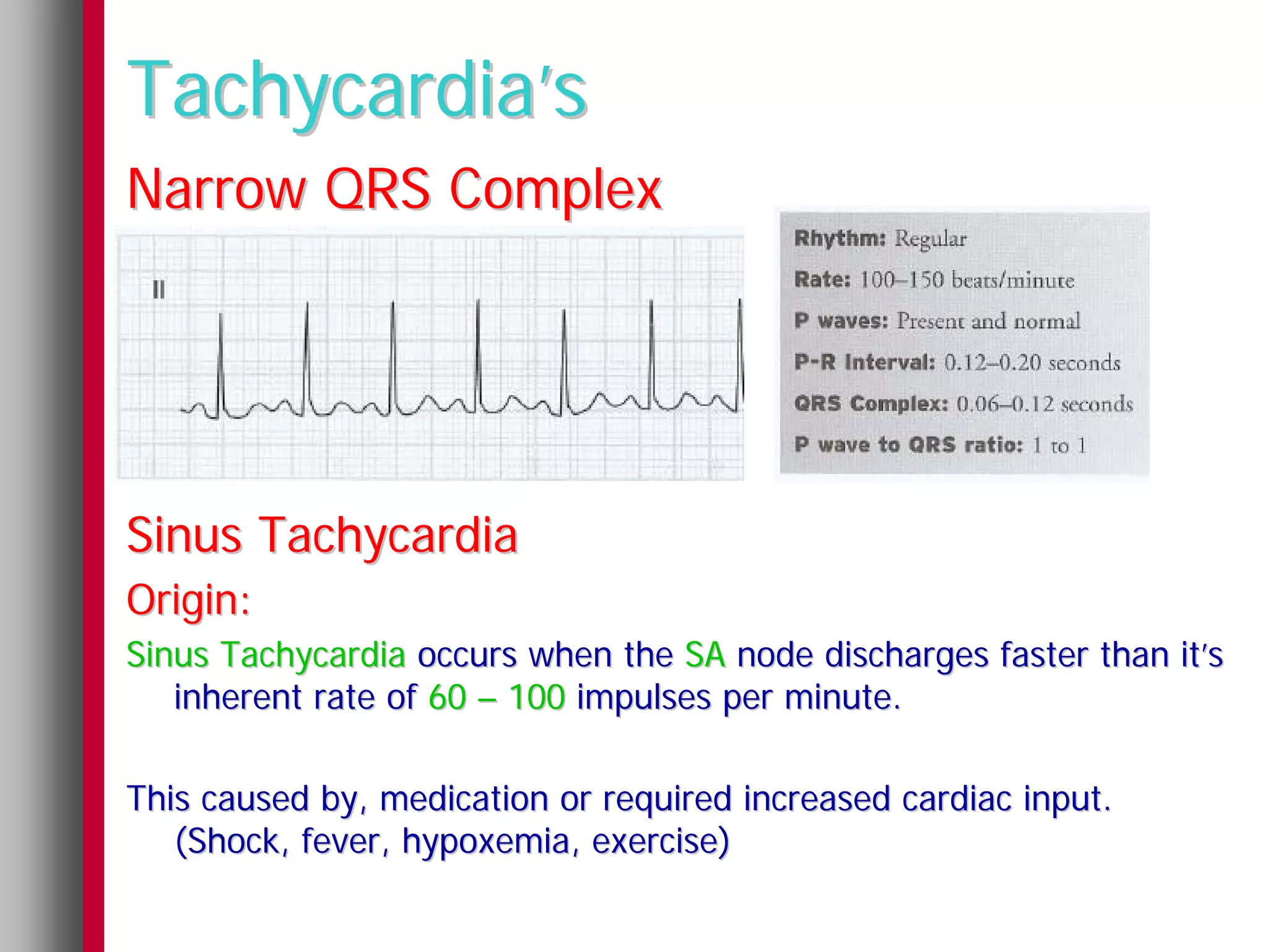Tachycardia’s
Narrow QRS Complex




Sinus Tachycardia
Origin:
Sinus Tachycardia occurs when the SA node discharges faster than it’s
   inherent rate of 60 – 100 impulses per minute.

This caused by, medication or required increased cardiac input.
   (Shock, fever, hypoxemia, exercise)
 