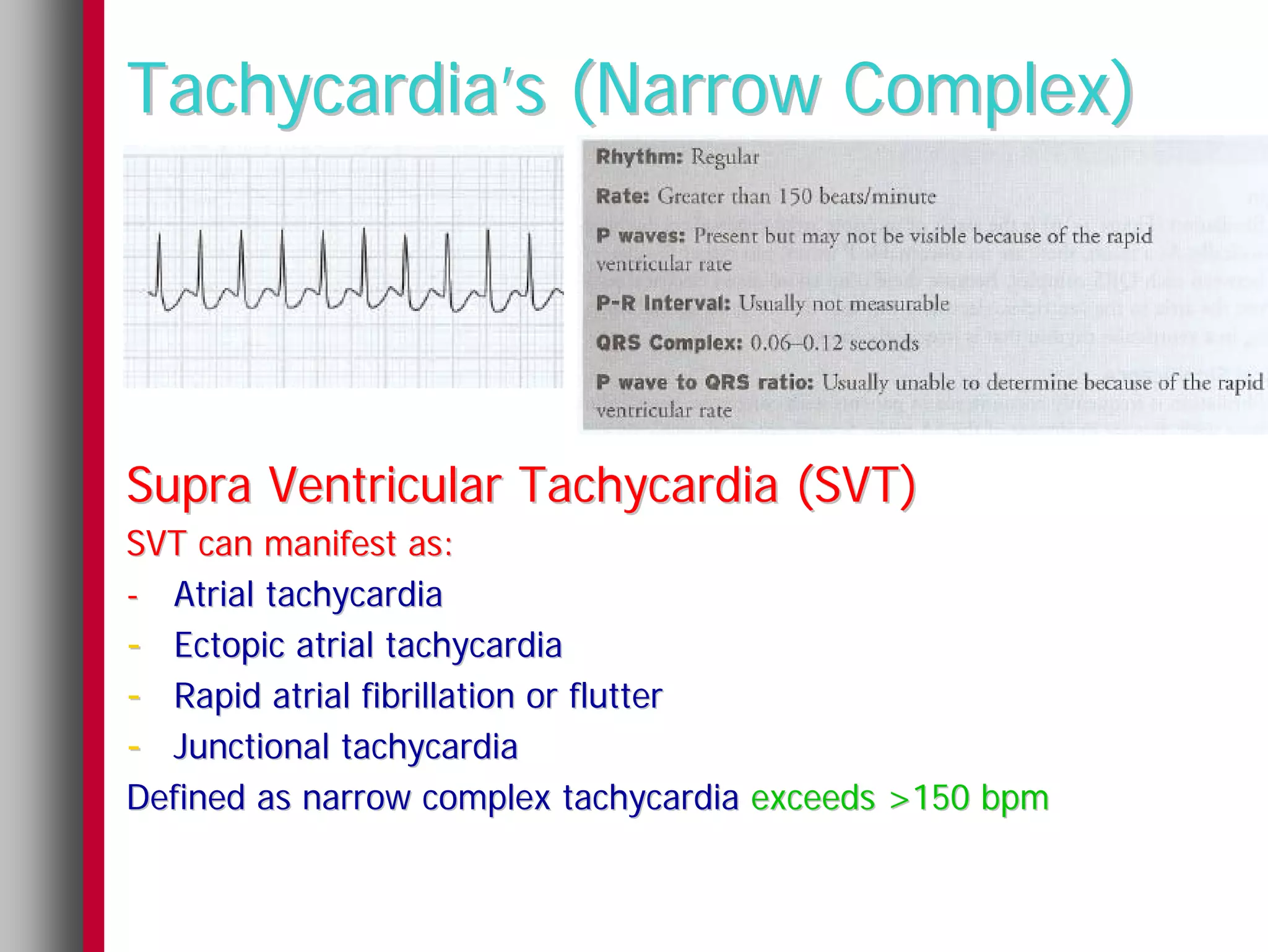 Tachycardia’s (Narrow Complex)




Supra Ventricular Tachycardia (SVT)
SVT can manifest as:
- Atrial tachycardia
- Ectopic atrial tachycardia
- Rapid atrial fibrillation or flutter
- Junctional tachycardia
Defined as narrow complex tachycardia exceeds >150 bpm
 