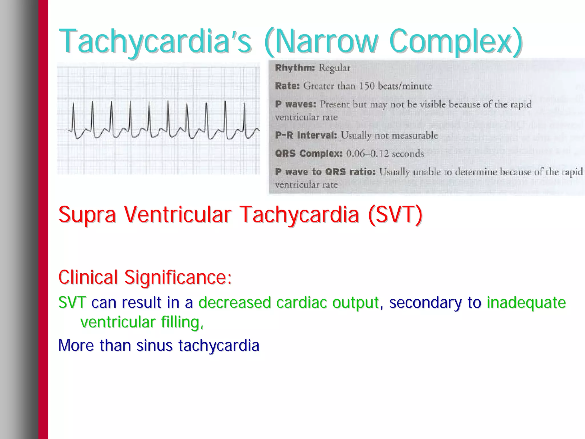 Tachycardia’s (Narrow Complex)




Supra Ventricular Tachycardia (SVT)

Clinical Significance:
SVT can result in a decreased cardiac output, secondary to inadequate
  ventricular filling,
More than sinus tachycardia
 