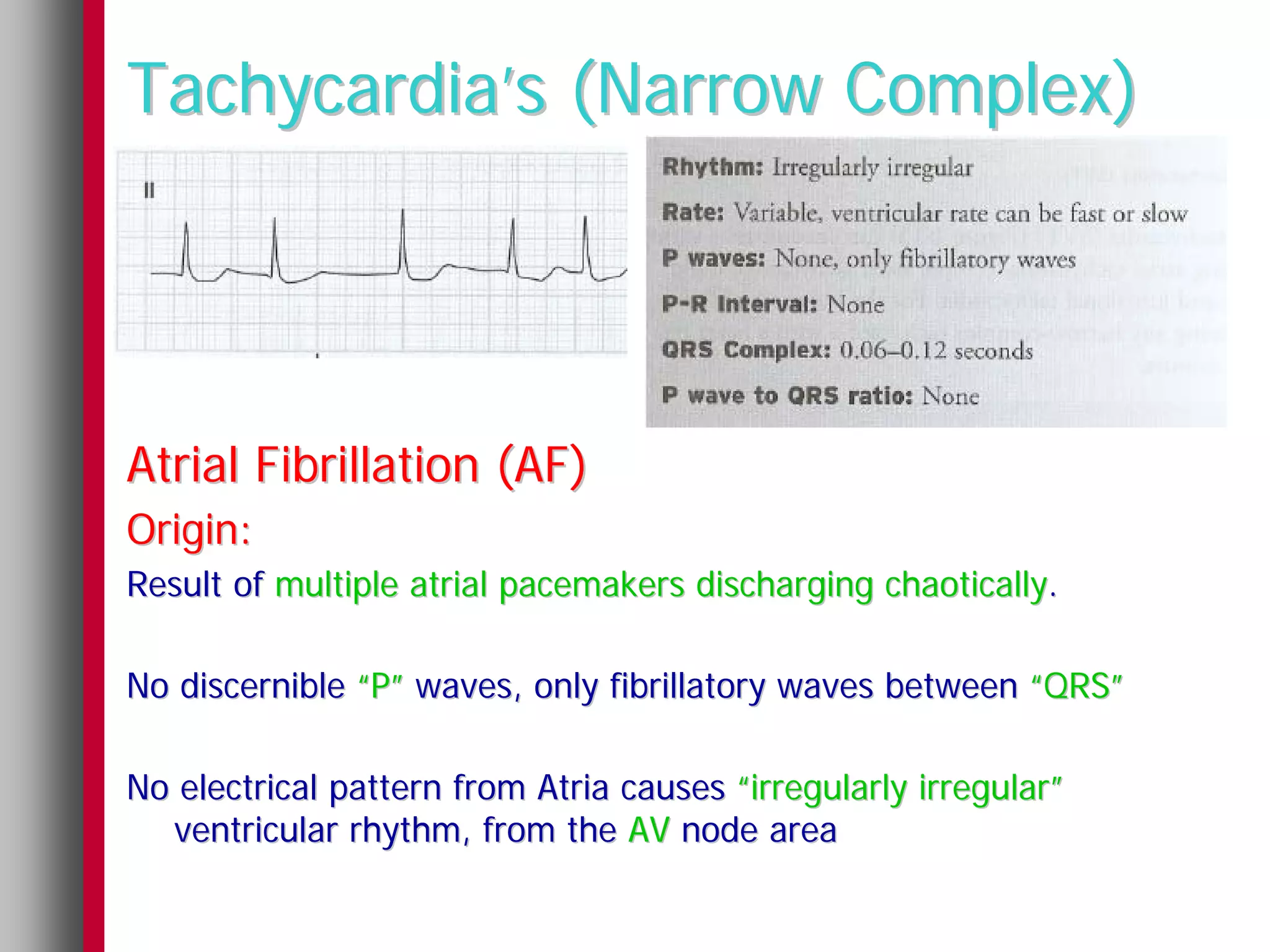 Tachycardia’s (Narrow Complex)




Atrial Fibrillation (AF)
Origin:
Result of multiple atrial pacemakers discharging chaotically.

No discernible “P” waves, only fibrillatory waves between “QRS”

No electrical pattern from Atria causes “irregularly irregular”
  ventricular rhythm, from the AV node area
 