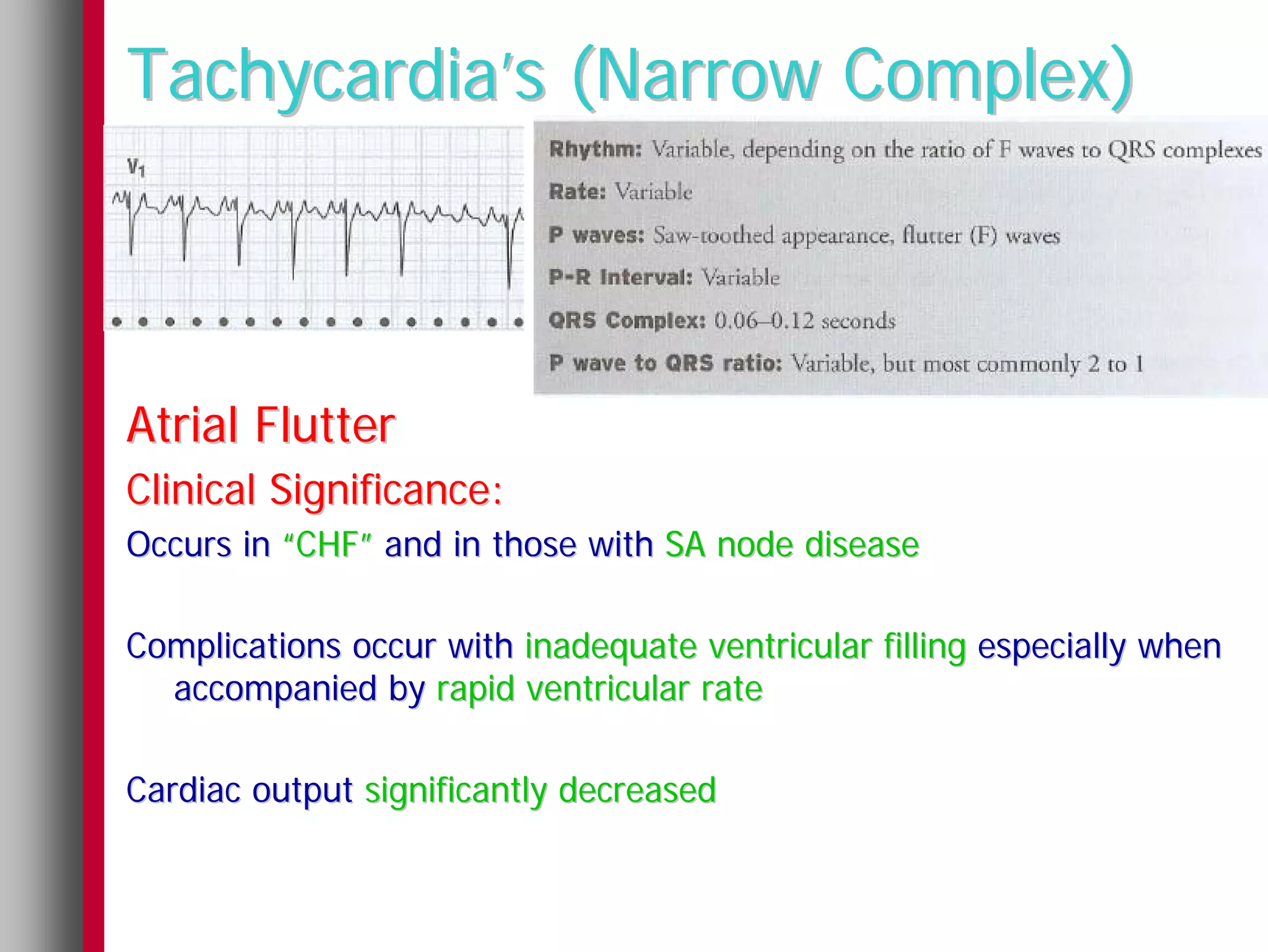 Tachycardia’s (Narrow Complex)



Atrial Flutter
Clinical Significance:
Occurs in “CHF” and in those with SA node disease

Complications occur with inadequate ventricular filling especially when
  accompanied by rapid ventricular rate

Cardiac output significantly decreased
 