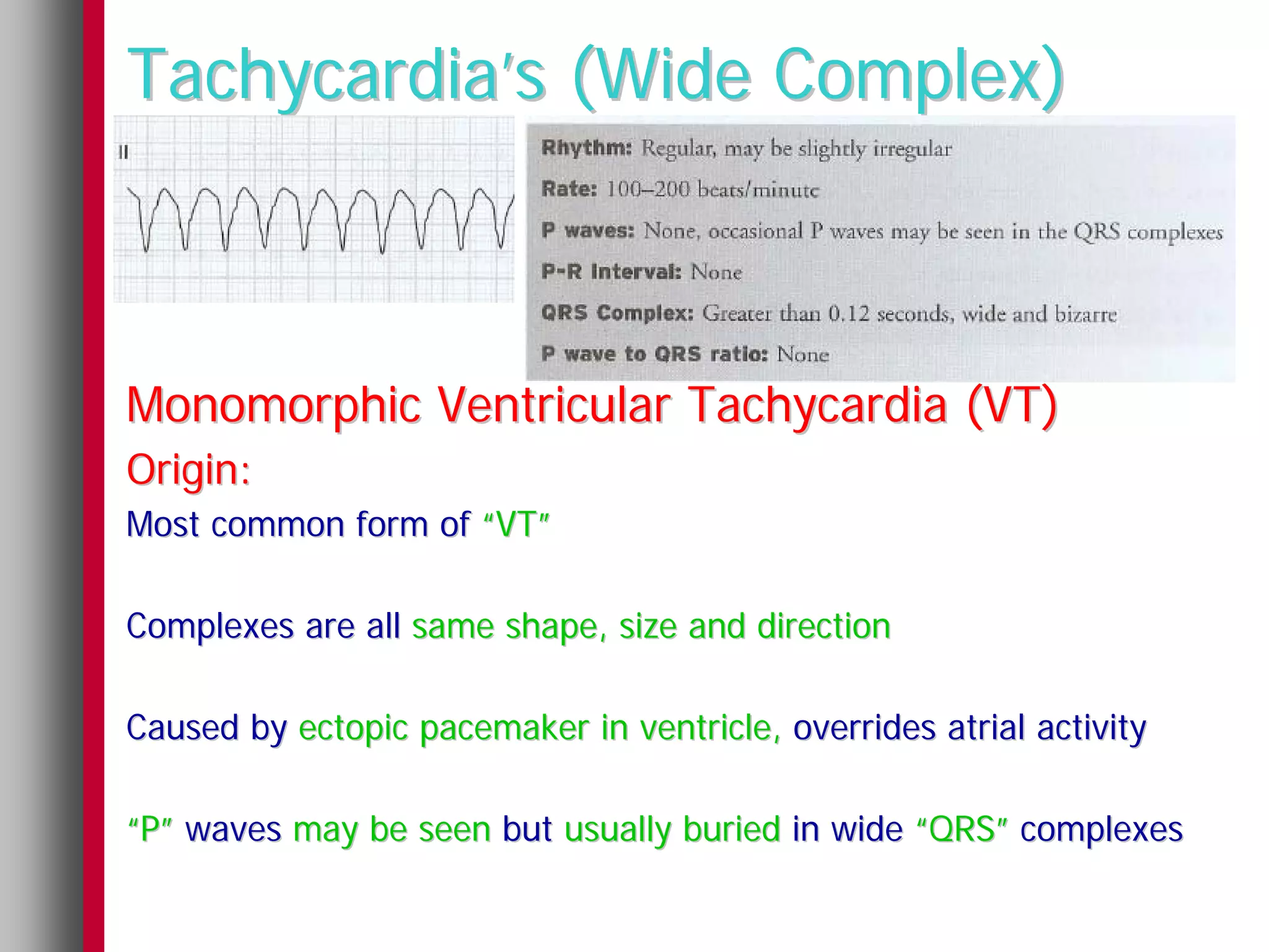 Tachycardia’s (Wide Complex)



Monomorphic Ventricular Tachycardia (VT)
Origin:
Most common form of “VT”

Complexes are all same shape, size and direction

Caused by ectopic pacemaker in ventricle, overrides atrial activity

“P” waves may be seen but usually buried in wide “QRS” complexes
 