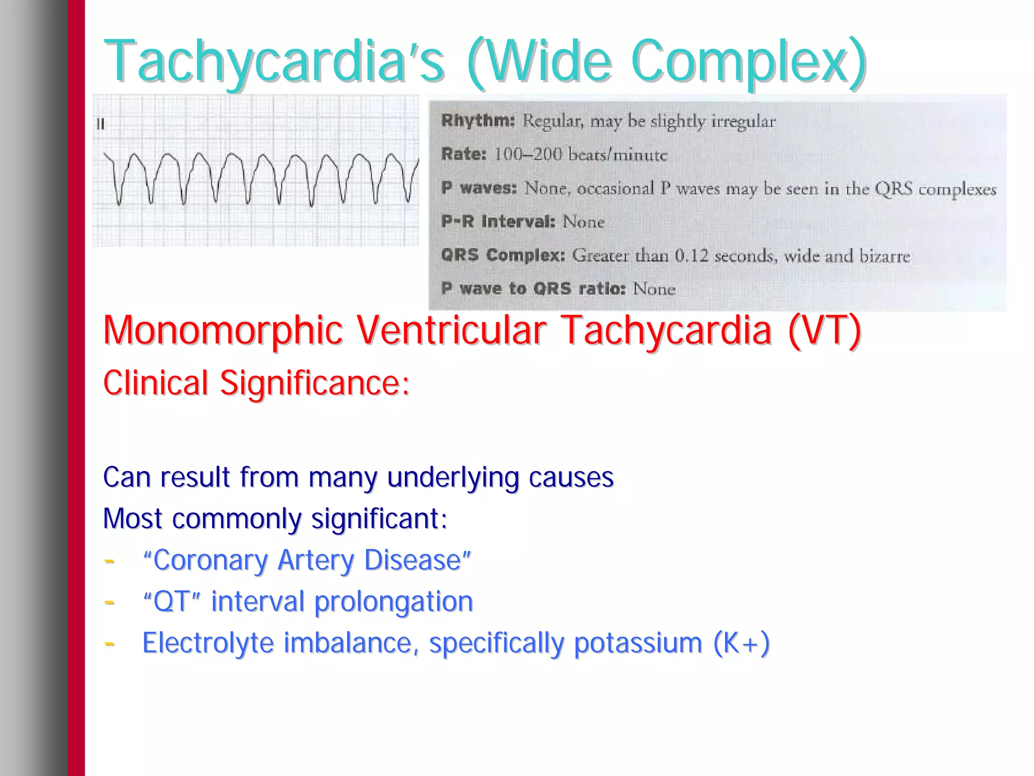 Tachycardia’s (Wide Complex)



Monomorphic Ventricular Tachycardia (VT)
Clinical Significance:

Can result from many underlying causes
Most commonly significant:
- “Coronary Artery Disease”
- “QT” interval prolongation
- Electrolyte imbalance, specifically potassium (K+)
 