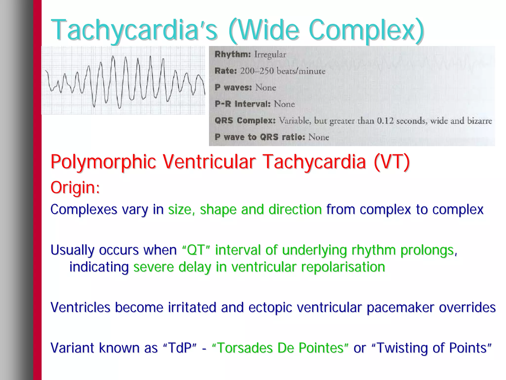 Tachycardia’s (Wide Complex)



Polymorphic Ventricular Tachycardia (VT)
Origin:
Complexes vary in size, shape and direction from complex to complex

Usually occurs when “QT” interval of underlying rhythm prolongs,
  indicating severe delay in ventricular repolarisation

Ventricles become irritated and ectopic ventricular pacemaker overrides

Variant known as “TdP” - “Torsades De Pointes” or “Twisting of Points”
 