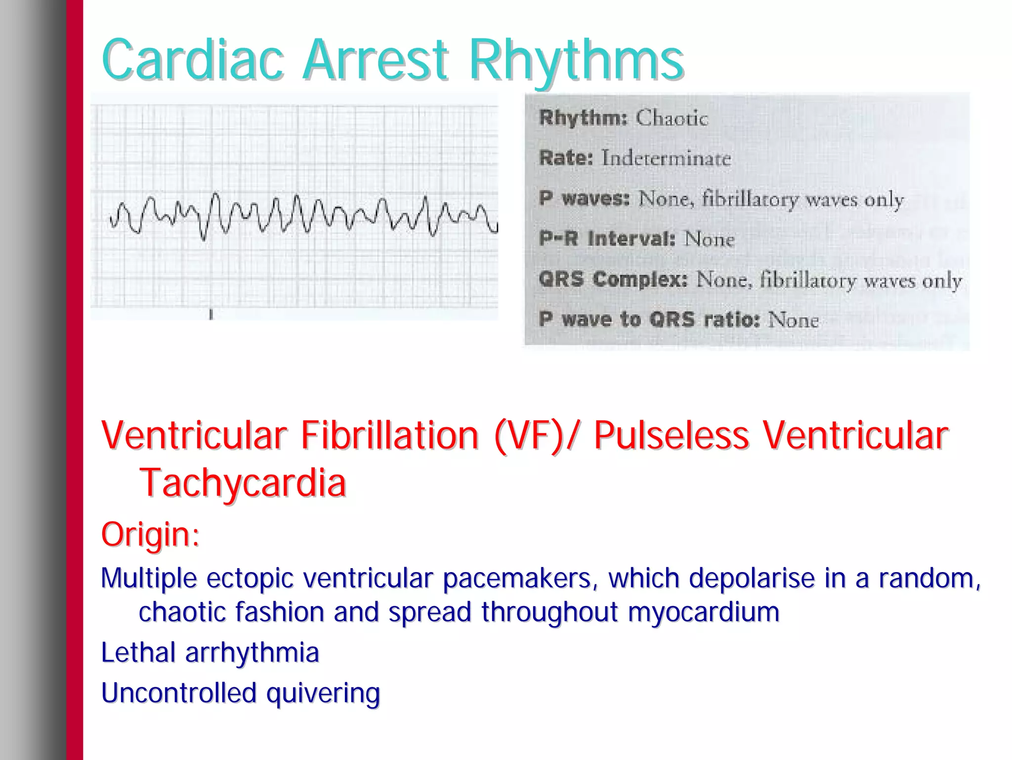 Cardiac Arrest Rhythms




Ventricular Fibrillation (VF)/ Pulseless Ventricular
  Tachycardia
Origin:
Multiple ectopic ventricular pacemakers, which depolarise in a random,
   chaotic fashion and spread throughout myocardium
Lethal arrhythmia
Uncontrolled quivering
 