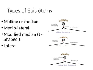 Epizeotomy Comprehensive Overview of Episiotomy: Indications, Procedure, and Care ...